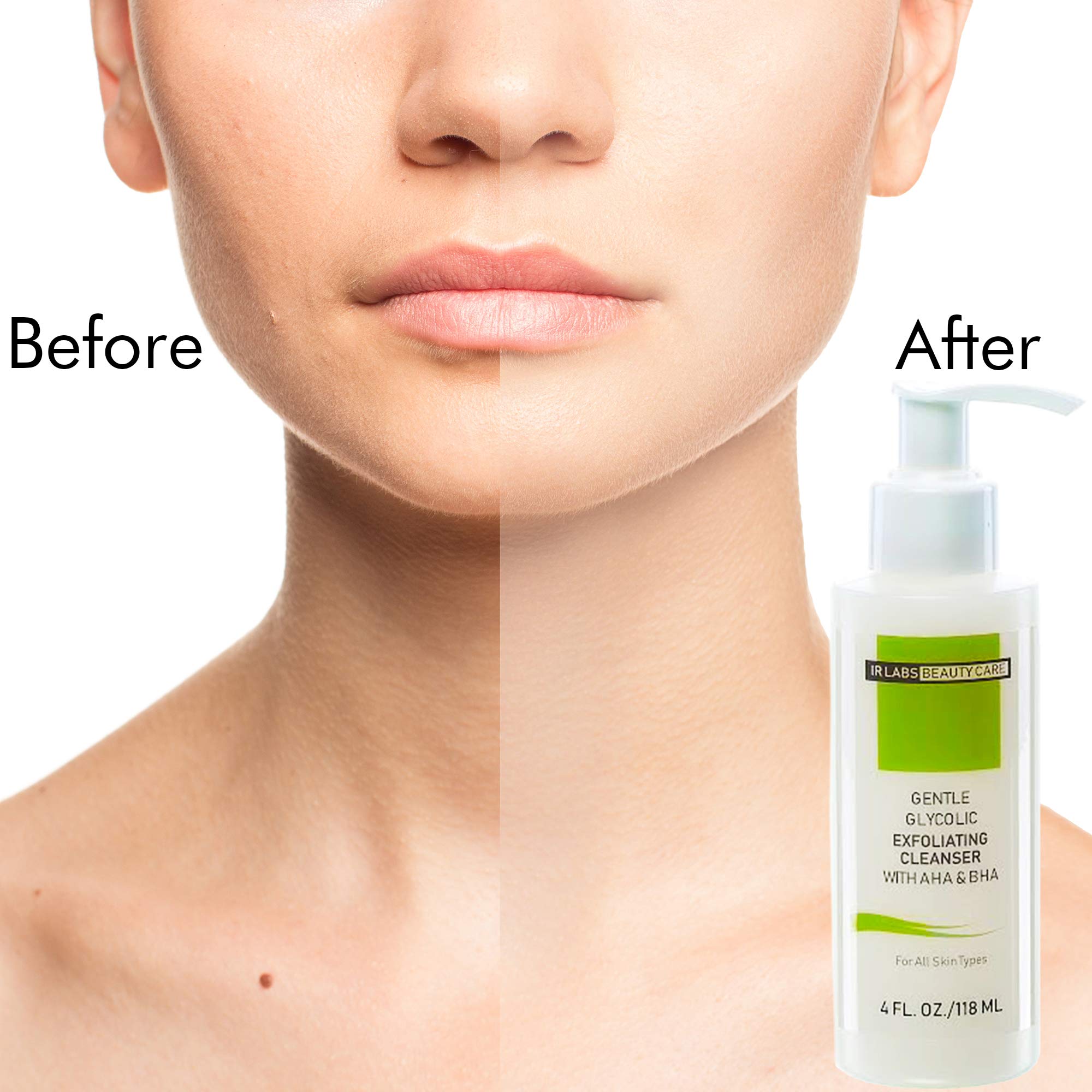 Glycolic Acid Exfoliating Cleanser, Acne Treatment, Gentle Acne And Face Wash With AHA And BHA, Anti-Aging Face Wash, Reduces Spots, Acne And Fine Lines, Deep Cleanse For All Skin Types  