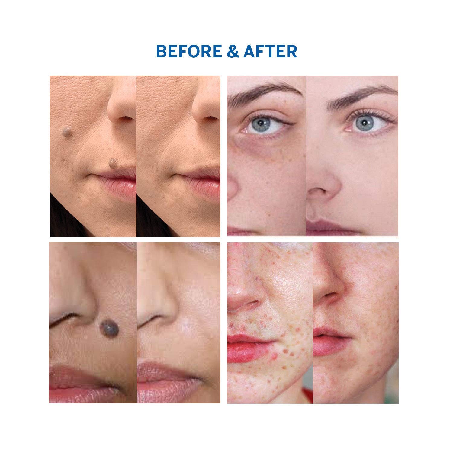 Amada Pure Mole Corrector & Skin Tag Remover and Repair Lotion Set, Remove Moles and Skin Tags Easy at Home Use : Beauty