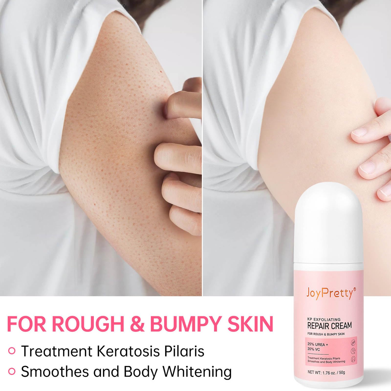 Strawberry Legs Treatment For Women,Bump Eraser Body Scrub, Keratosis Pilaris Treatment,Rough Bumpy Body Cream, Bump Eraser Body Scrub,Smoothing & Buffing Body Scrub Body Care