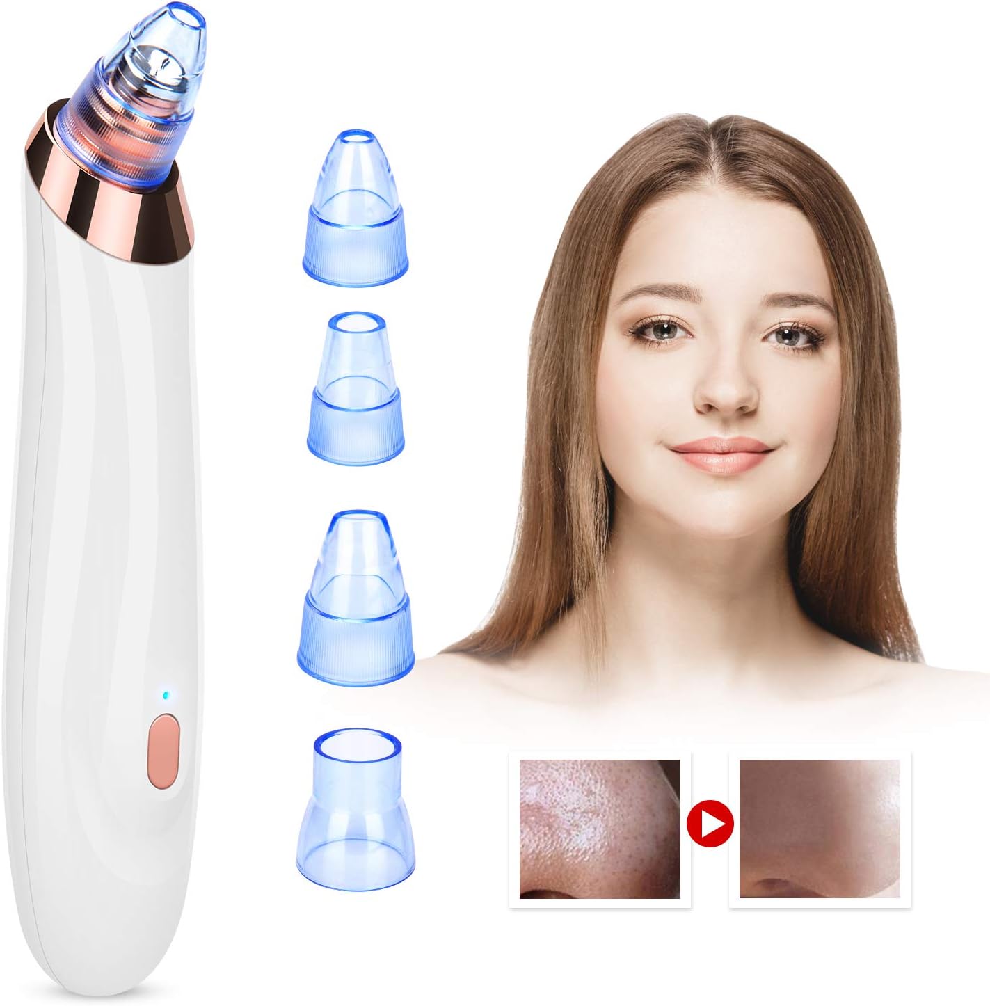 Blackhead Remover Vacuum,WloveTravel Electric Skin Pore Vacuum Cleanser Blackhead Extractor Tool with 5 Replaceable Suction Heads,3 Adjustable Suction Levels
