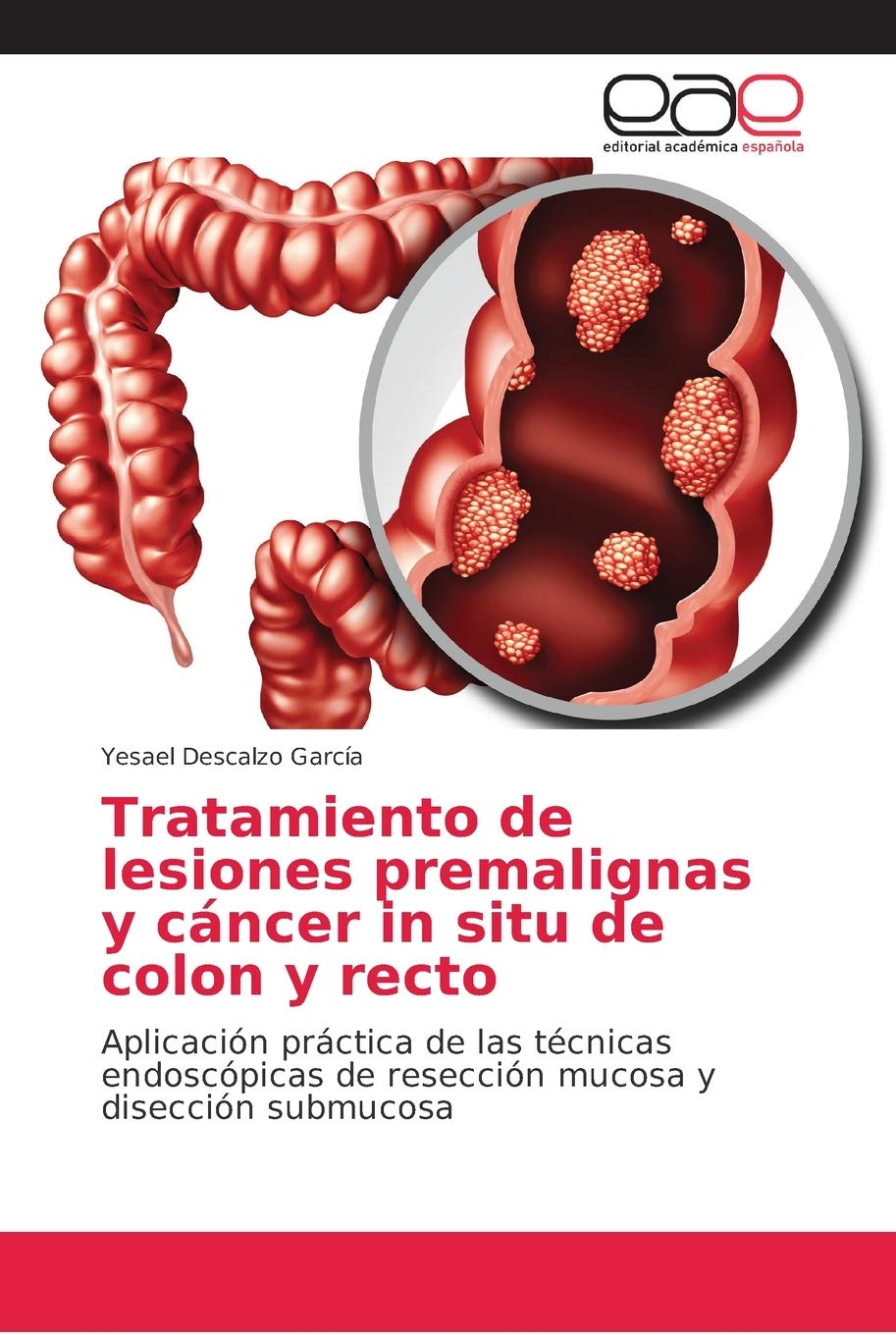 Tratamiento De Lesiones Premalignas Y Cancer In Situ De Colon Y Recto Aplicacion Practica De Las Tecnicas Endoscopicas De Reseccion Mucosa Y Diseccion Submucosa Spanish Edition Descalzo Garcia Yesael Amazon Com Books
