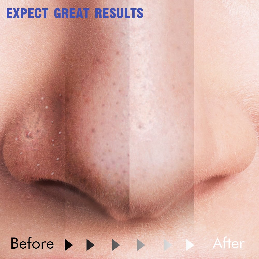 Mckbane Electric Blackhead Remover (Newest Version) Portable Facial Pore Acne Comedo Cleanser Blackhead Suction Device Skin Care Tool Set of White with 4 Heads USB Rechargeable for Women Men (White)