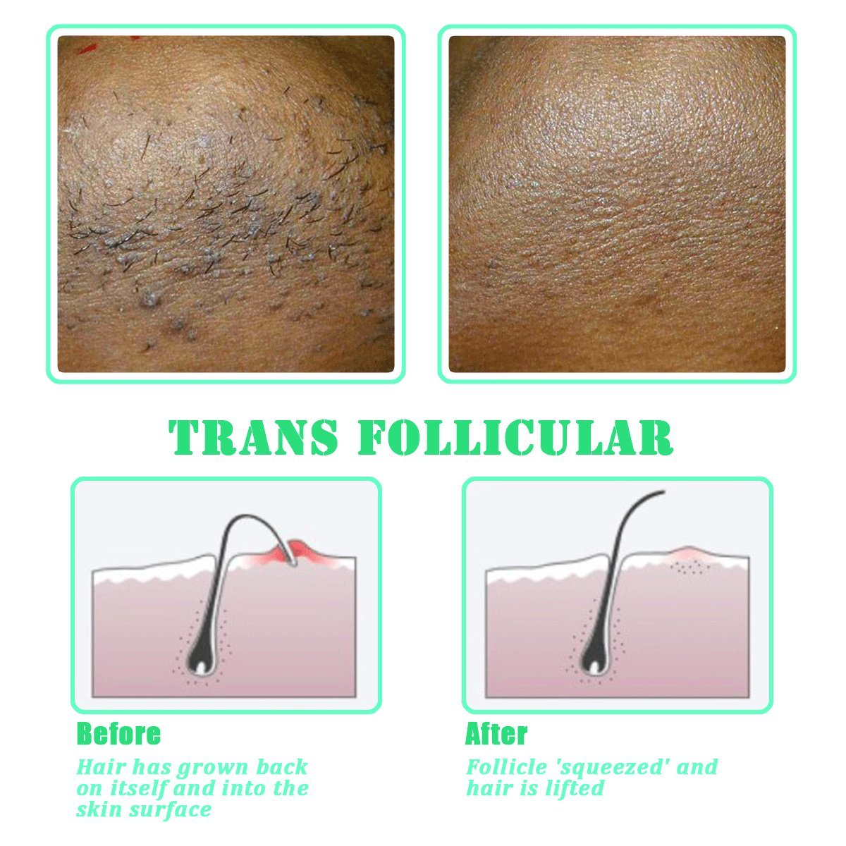 Tailaimei Exfoliating Brush For Ingrown Hair Treatment To Treat