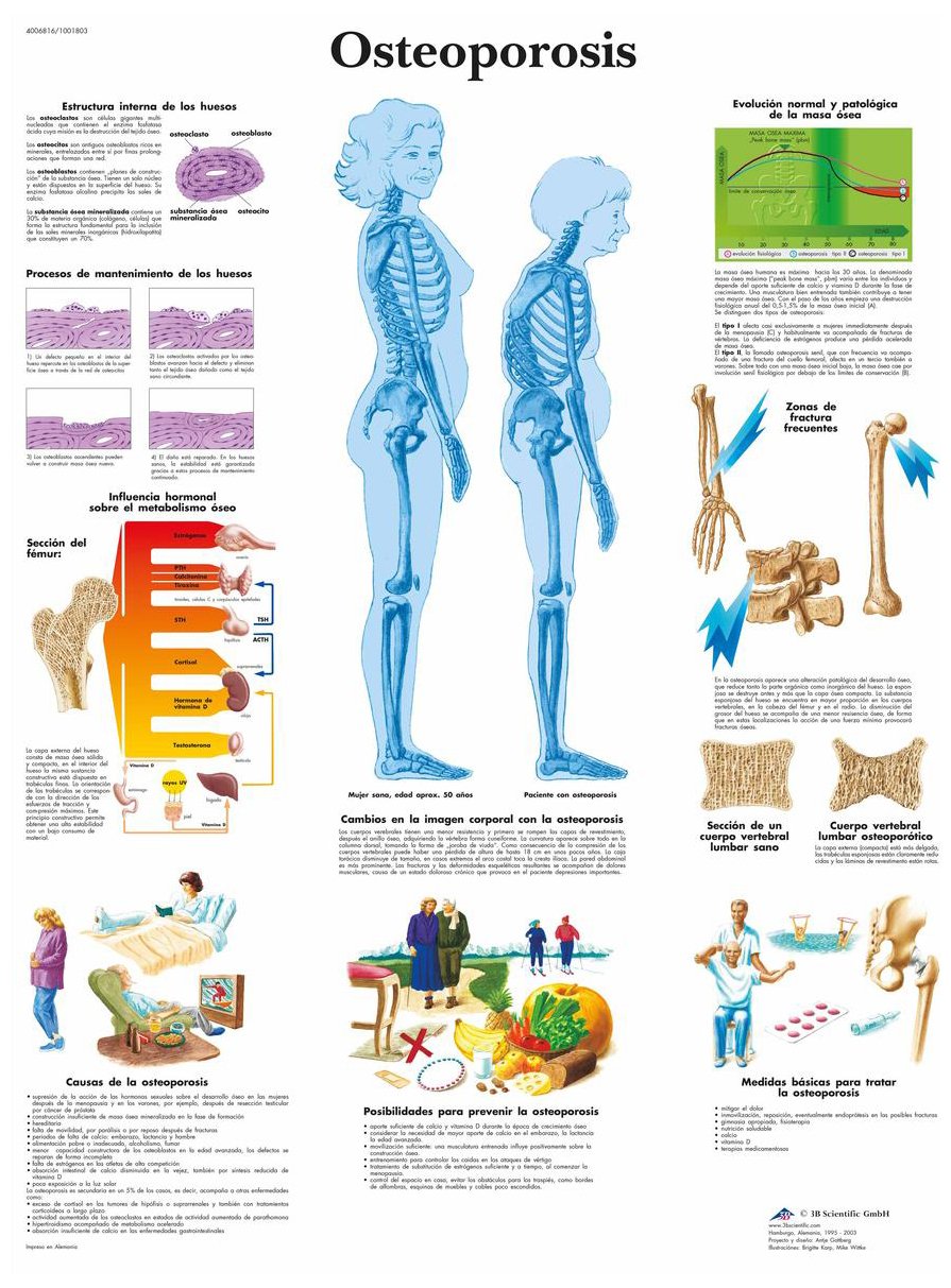 3B Scientific Printed in Paper, Osteoporosis, 1