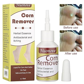 corn on heel removal