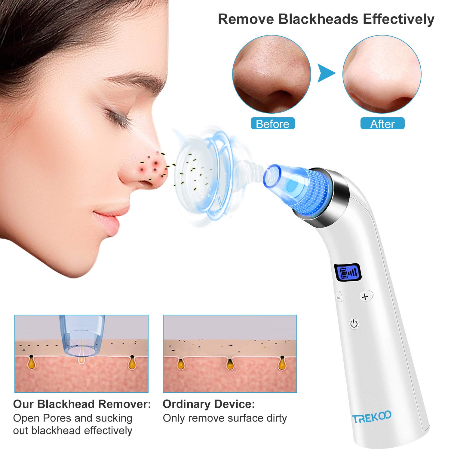 Blackhead Remover Vacuum - Electric Blackhead&Blemish Removers Pore Vacuum Suction Device Cleaner Extractor Tool Beauty Comedo Removal for Men&Women: Beauty
