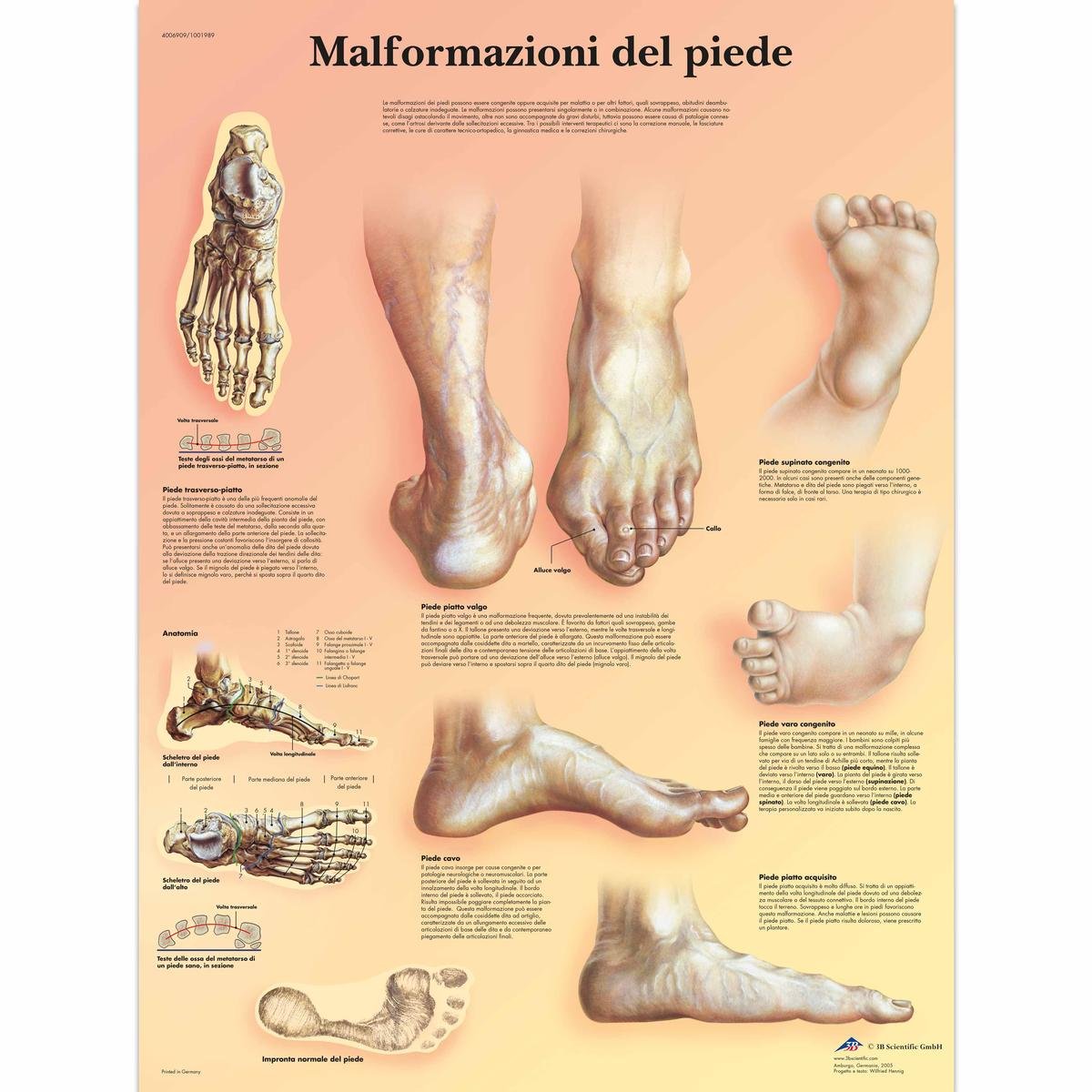 3B Scientific VR4185UU Anatomical Chart "Malformazioni di Piede", Paper Version