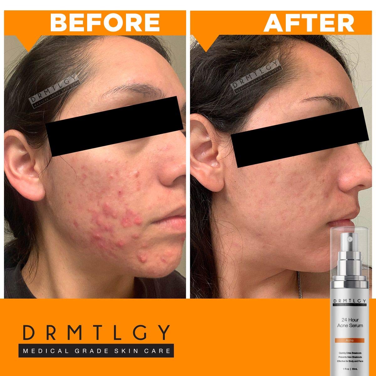 serum for cystic acne