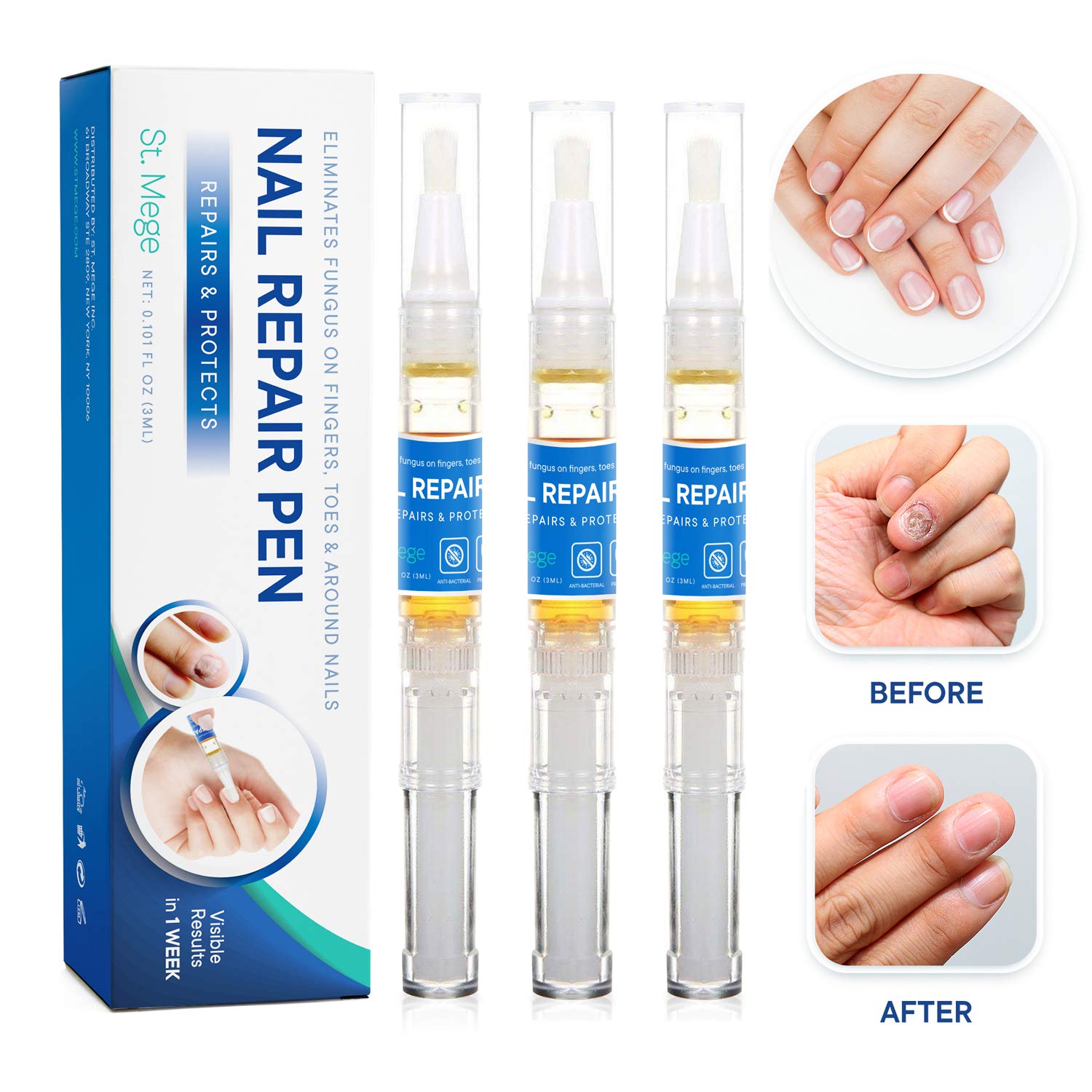 St. Mege Fungus Nail Repair Pen, Natural Fungal Nail Care Solution for