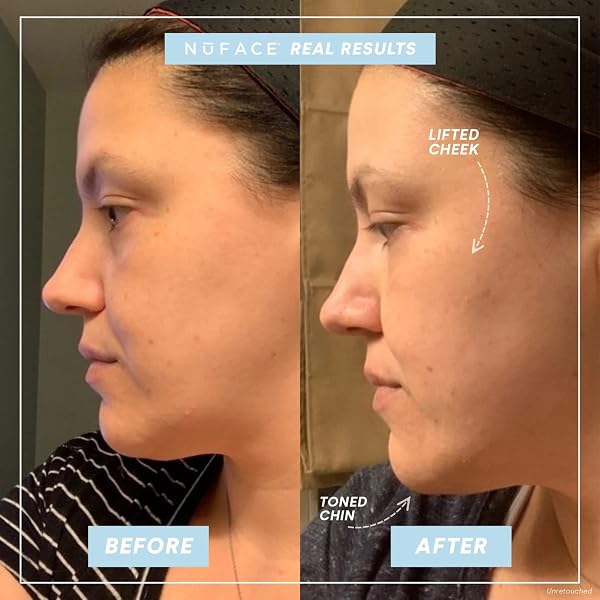 NUFACE TRINITY COMPLETE – FACIAL TONING KIT
