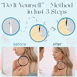 TagCure Skin Tag Removal Kit - Includes 10 Tag Bands, 10 Swabs & 10 Plasters view 7