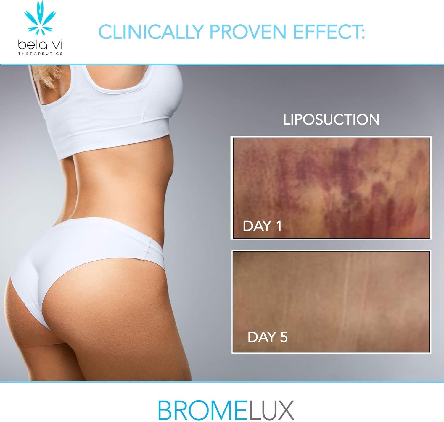 BROMELUX Anti-Bruising Supplement I Bromelain & Quercetin Complex: Swelling & Bruise Relief, Natural Anti-Inflammatory Treatment I for Daily Care & Recovery After Surgery & Skin Trauma I 60 Capsules: Health & Personal Care