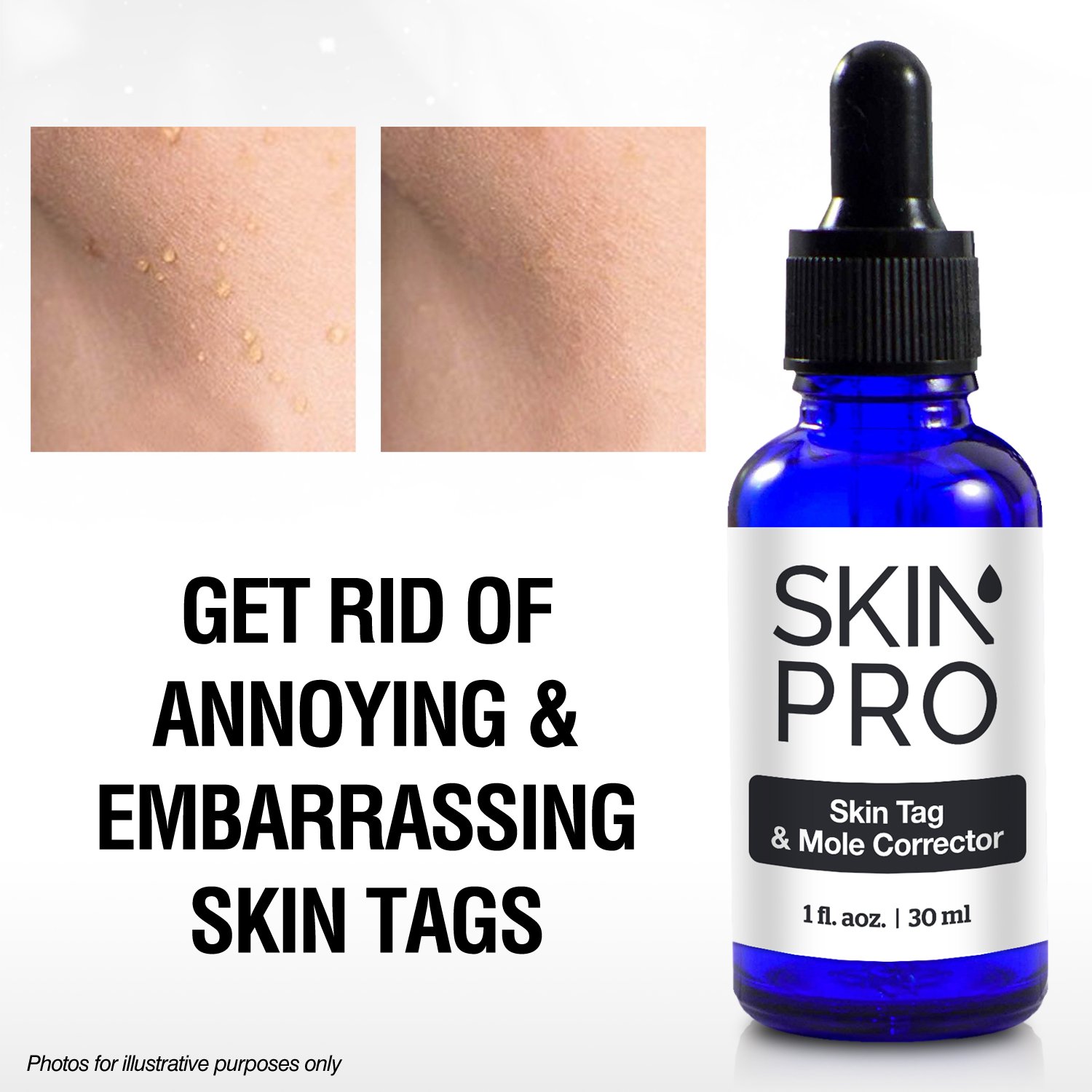 SkinPro Skin Tag Remover And Mole Corrector For Fast Removal Of Skin Moles, Skin Tags, Warts And Other Minor Growths, Medical Grade Formula with 17% Salicylic Acid (1 fl oz, 30 ml) : Beauty