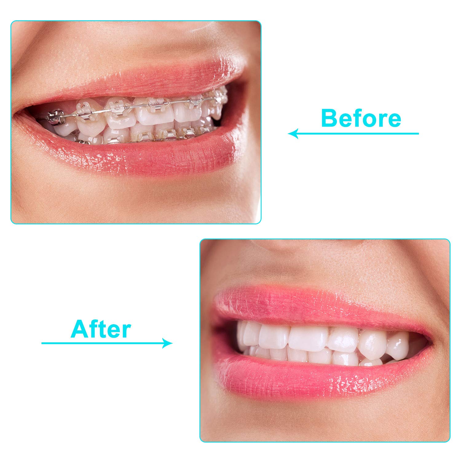 20 Pieces Aligner Tray Seaters Chewies for Aligner Trays Chompers Aligner Trays 5 Colors : Beauty