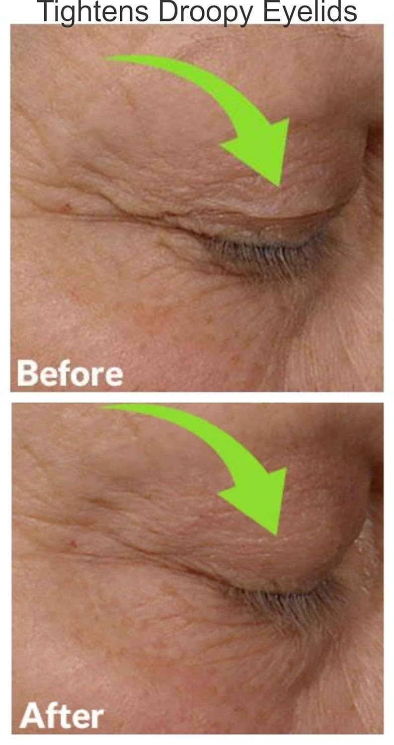 fine lines on eyelids