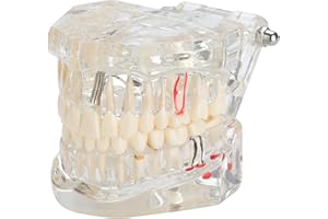 Healthible Transparent Dental Implant Disease Teeth Model - Dental Education Implant Teeth Model Transparent Disease Teeth Model Pathological Tooth Model with Removable Teeth