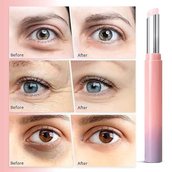 DARK CIRCLES UNDER EYE TREATMENT: RETINOL EYE CREAM UNDER EYE BRIGHTENER STICK FOR EYE BAGS WRINKLE DARK CIRCLE AND PUFFINESS – SUITABLE FOR WOMEN AND MEN