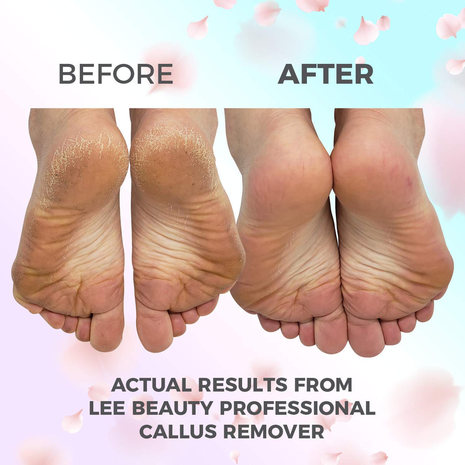 8oz Callus Remover gel for feet for a professional pedicure. Better results than, foot file, pumice stone, foot scrubber, foot buckets & callus shaver. Rid ugly callouses from feet in minutes!: Beauty