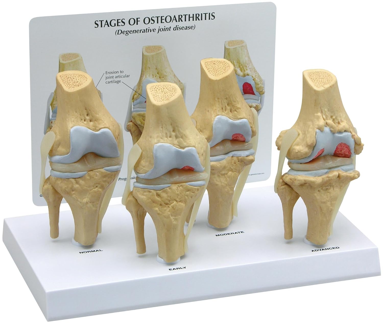 4Stage Osteoarthritis Knee Joint Model Industrial