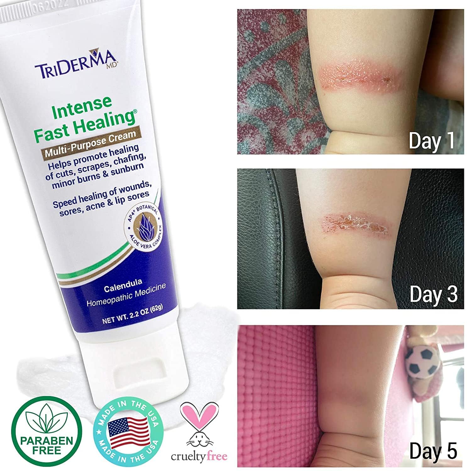 TriDerma Intense Fast Skin Healing Cream for Hard-to-Heal Skin Irritations, Sores, Rashes, Dry, Cracked Hands, Cuts, Chafing, Burns, Scrapes - First Aid Kit Essential - FSA Eligible - 2.2 oz