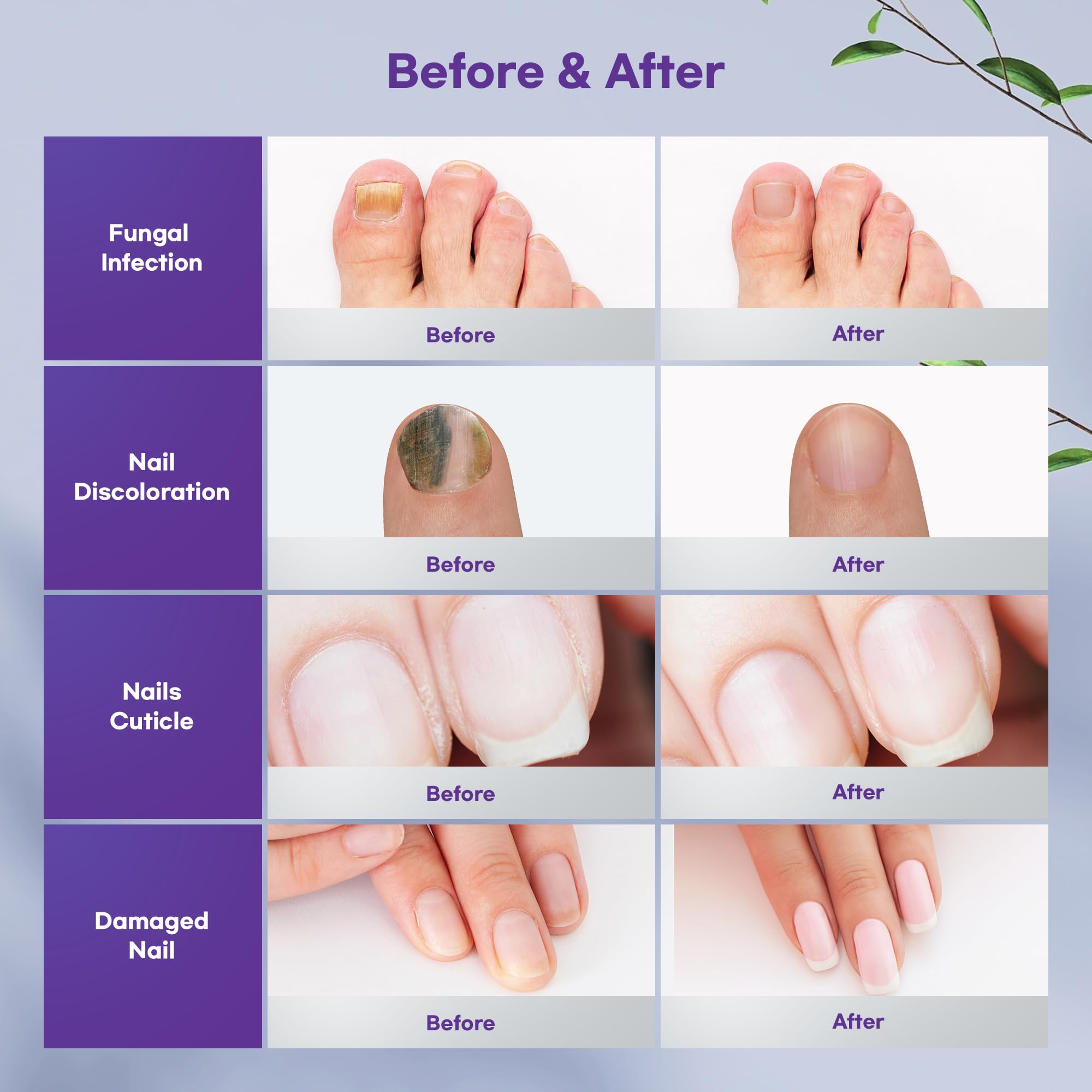 Nail Fungus Treatment For Toenail Spray - 3-In-1 Toe Nail Fungus Treatment Extra Strengt - Toenail Fungus Treatment Renews and Strengthens Nails (100ml) - Image 7