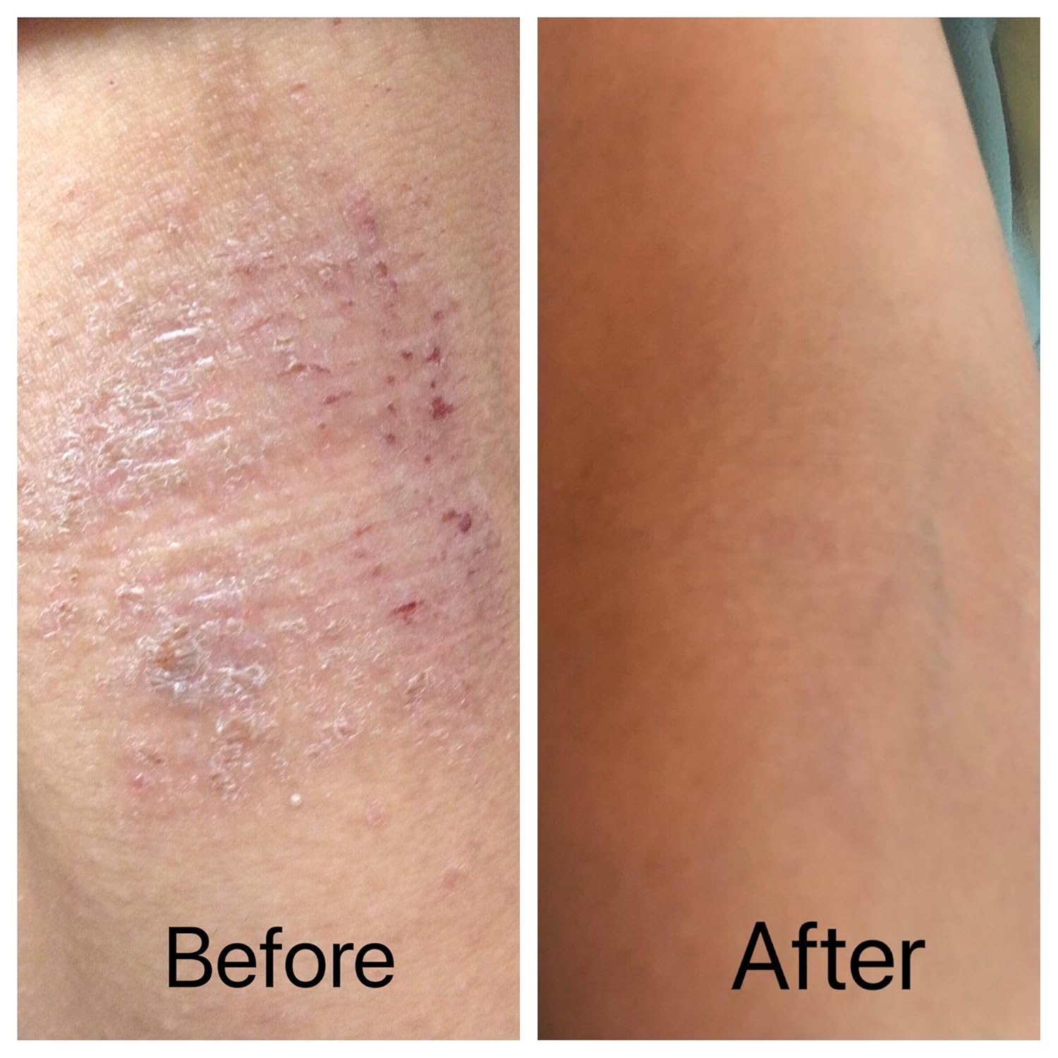 Amazon Com Mitlow Herbal Eczema Balm Natural Eczema Relief Cream Natural Moisturizer For Dry Skin Helps Dermatitis Itching Rash Handmade Amazon Com Mitlow Herbal Eczema Balm Natural Eczema Relief Cream Natural Moisturizer For Dry Skin Helps Dermatitis Itching Rash Handmade