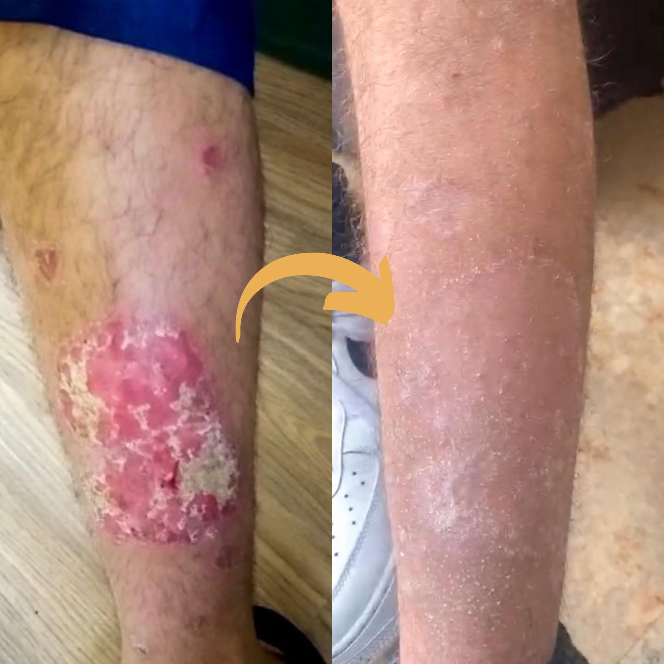 Strength & Spices Psoriaskin Supplement, Immune System Booster with 31 Powerful Ingredients and Amino Acids, Soothes Red, Flaky Skin, 1000 mg, 60 Vegan Capsules