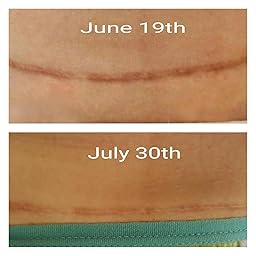 Amazon.com: Customer reviews: ScarAway C-Section Scar Treatment Strips ...