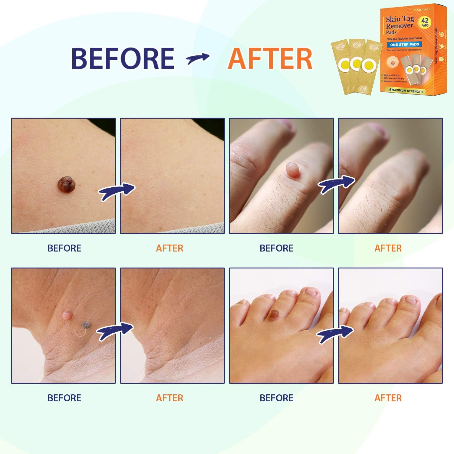 Samsali Advanced Skin Tag Remover Pads, 42 Quality Skin Tag Remover Pads, Best Skin Tag Remover Pads: Health & Personal Care