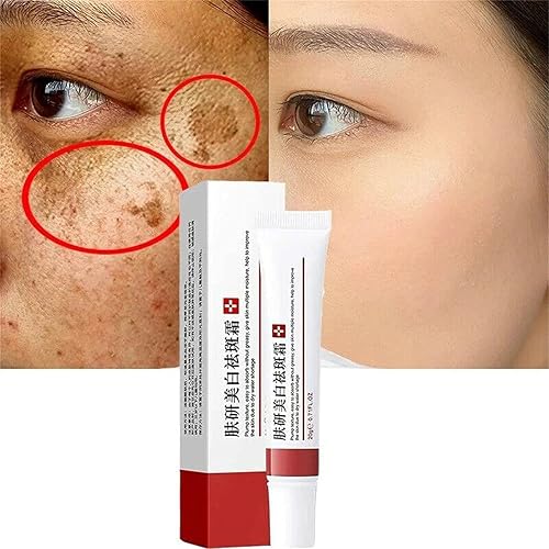 Gonice 2pcs Whitening Freckle Cream, Acne Scar Removal Treatment Cream, Pigmentation Removal
