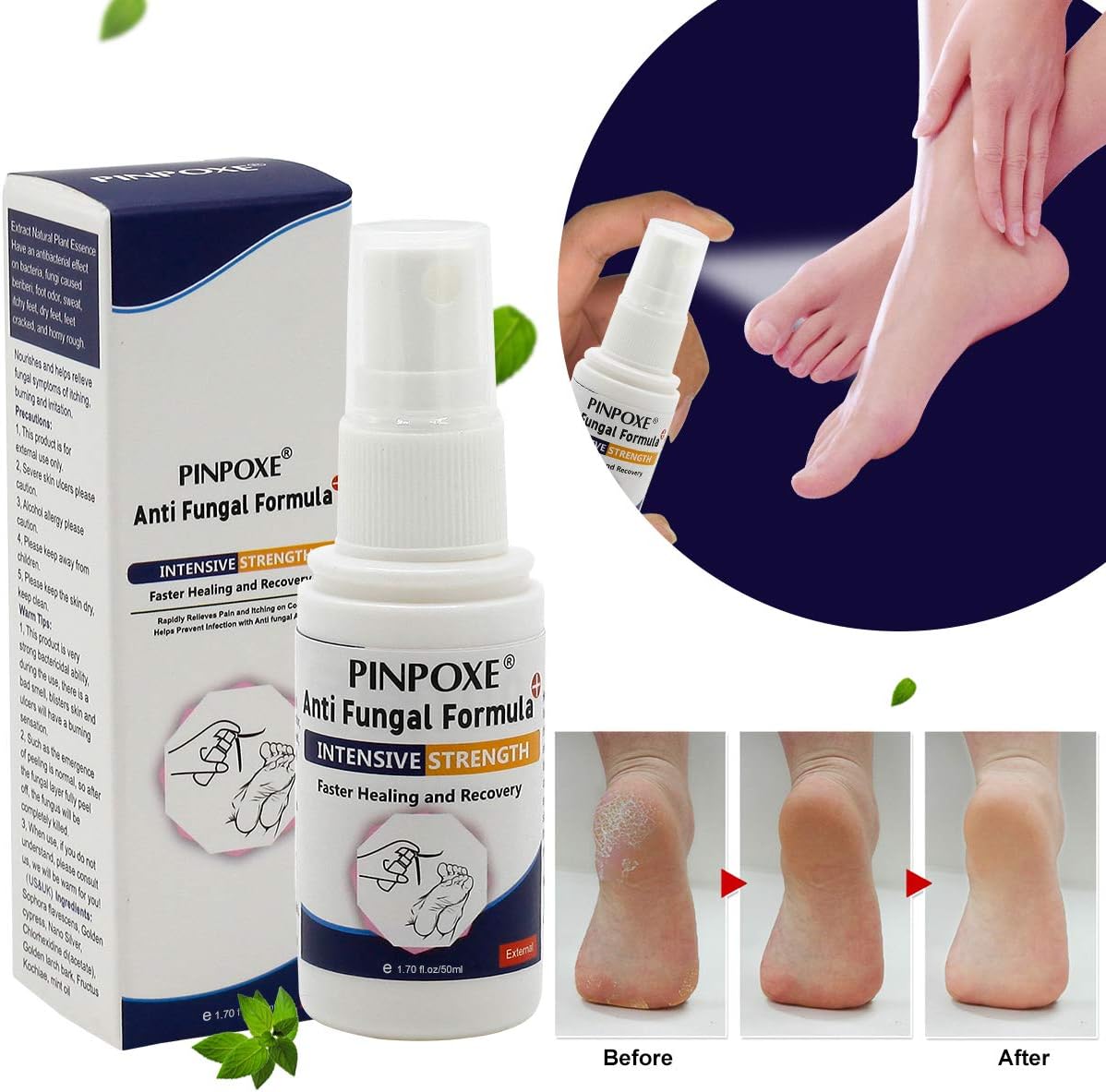 Foot Spray, Athletes Foot Spray, Athlete Foot Treatment, Fungus Feet