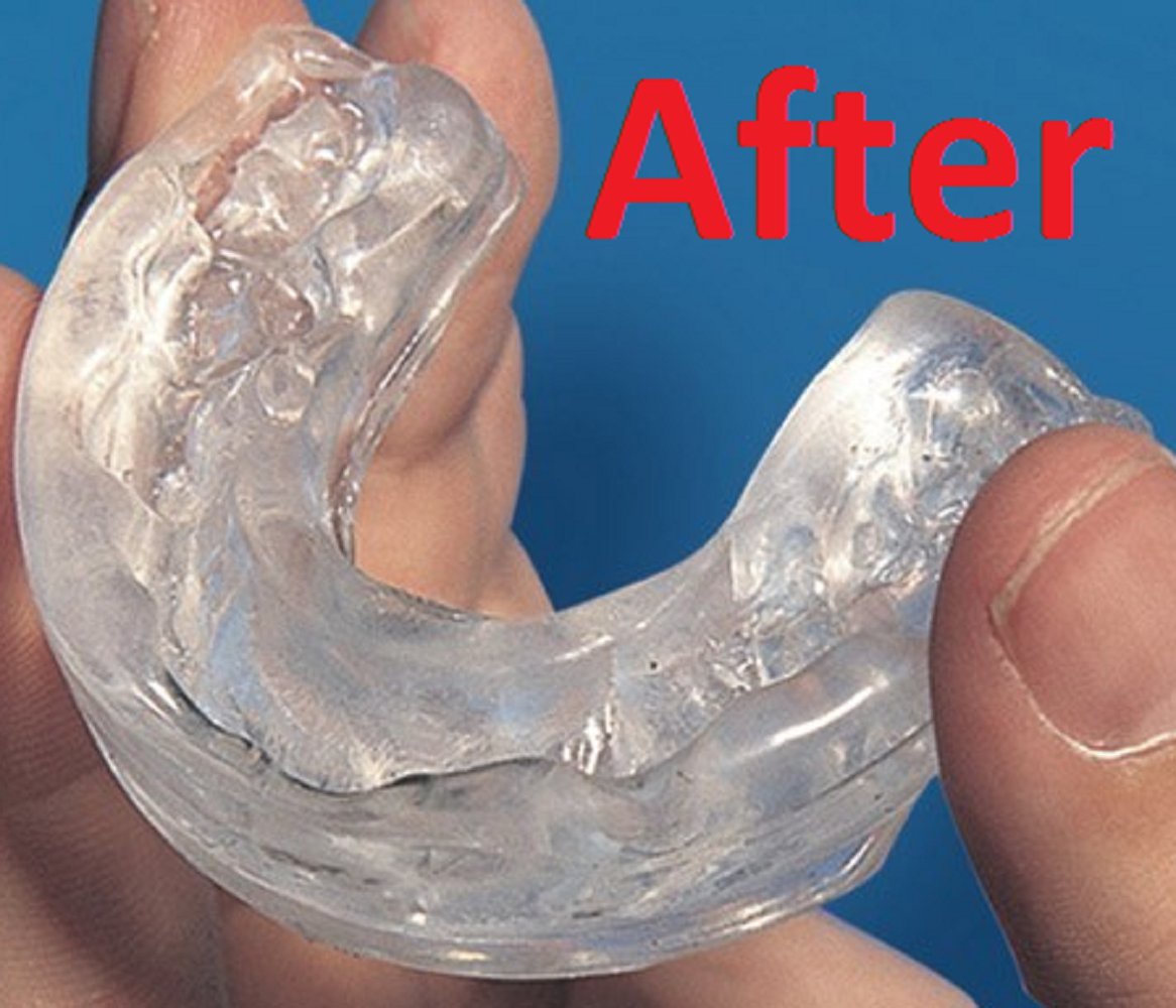 Stop Snoring Solution CustomFit Anti Snore Mouthpiece Guard Device