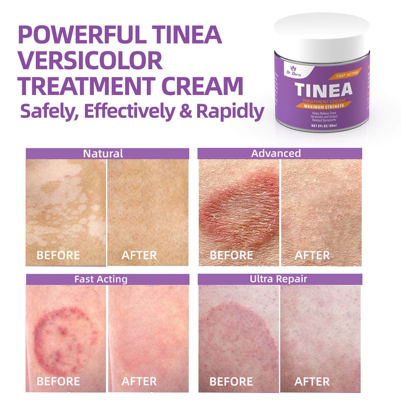 Mua Tinea Versicolor Treatment, Ringworm Treatment for Humans, Athletes ...