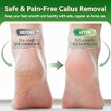 ShoRan Electric Foot File Remover, USB Rechargeable, 3 Rollers view 2
