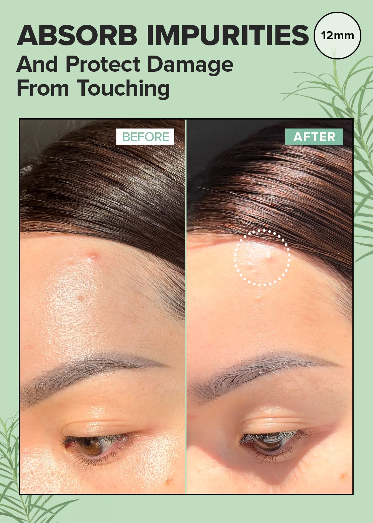 I DEW CARE Hydrocolloid Acne Pimple Patch - Timeout Blemish Plus | Korean zit Dark Spot Patches for face and skin, Pus absorbing with Tea Tree Leaf Oil, Facial Stickers, Large, 36 Count