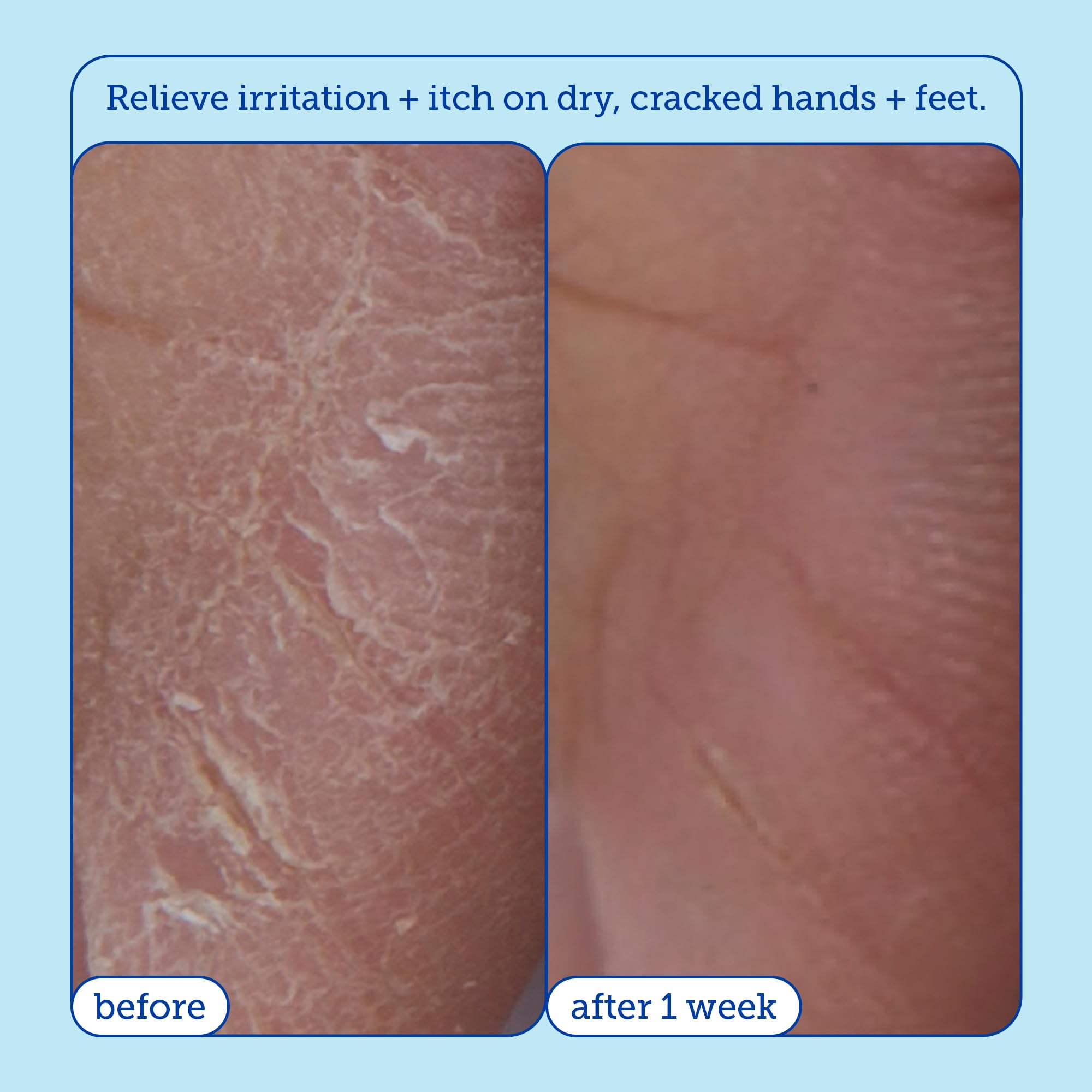 Skinfix Eczema+ Hydrating Hand Repair Cream: To Address Eczema & Dry, Cracked, Sensitive skin, 3 FL Oz