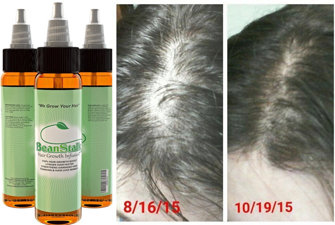 Beanstalk Hair Loss Treatment Promotes Fast Hair Growth In 2