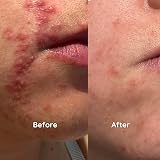 Salcura Antiac Activ Liquid Spray 100ml Oily Congested Acne Prone Skin view 2