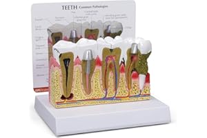 GPI Anatomicals - Human Teeth Anatomy Model with Common Dental Problems, Replica for Anatomy and Physiology Education, Anatomy Model for Doctor's Offices and Classrooms, Medical Learning Resources