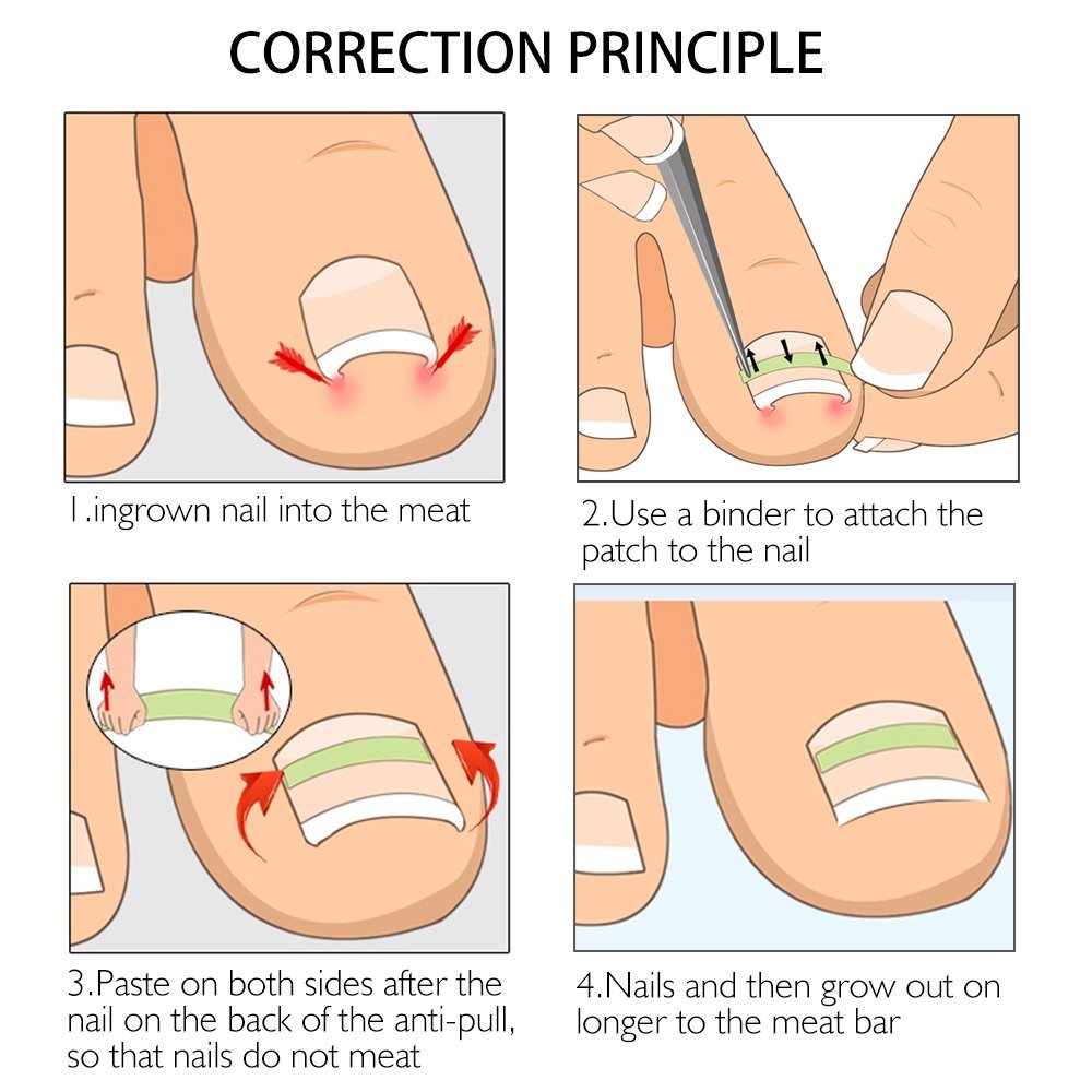 Ingrown Toenail Pedicure Tool 10pcs/bottle Straightening Clip Curved BS Brace Toenails Thick Paronychia Correction Tool Foot: Beauty