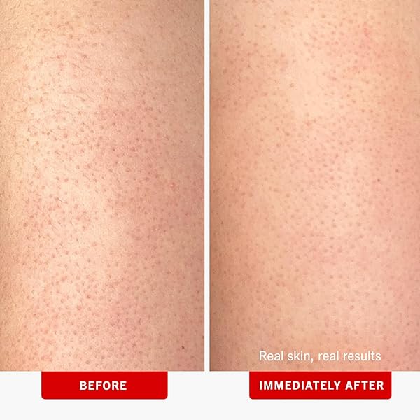 FIRST AID BEAUTY – KP BUMP ERASER BODY SCRUB WITH 10% AHA, KERATOSIS PILARIS SKIN EXFOLIATER WITH GLYCOLIC AND LACTIC ACIDS, HELPS REDUCE CHICKEN SKIN BUMPS, SAFE FOR SENSITIVE SKIN, 10 OZ