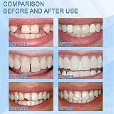 HIVETZ Temporary Tooth Filling Repair Kit Beads Moldable DIY Teeth view 3