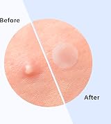 Aliobio Hydrocolloid Pimple Spot Patches 216 Dots Face Acne Treatment Skincare view 6
