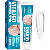 Vitiligo Treatment, Natural Vitiligo Cream for White Spots, 20g | For White Spots on Face or Body, Helps Improve Appearance of Skin Pigmentation, Gentle Daily Care