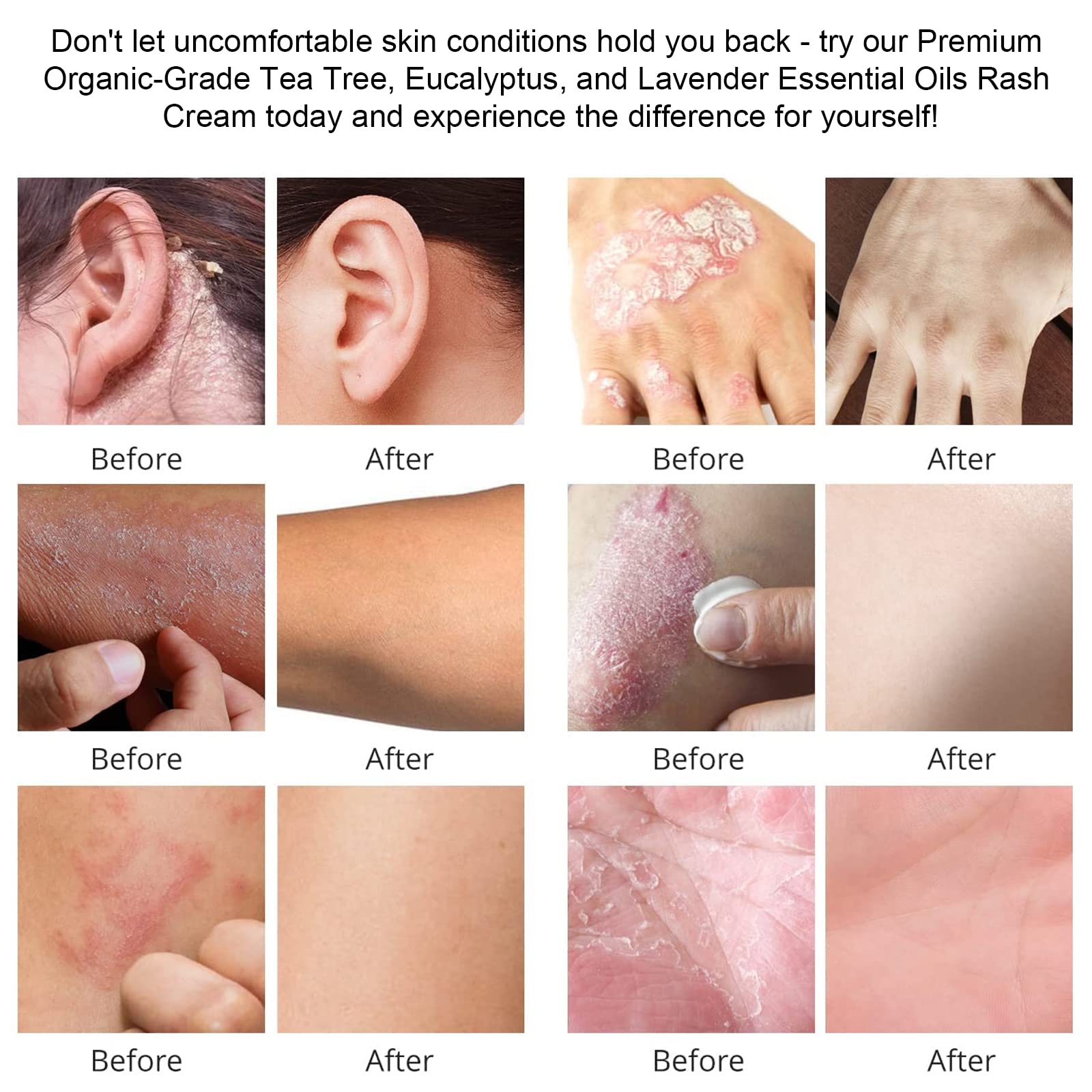 Draw Salve Eczema Cream Athlete's Itchy Foot Relief, Heat Rash, Anus Itch, Tinea Versicolor, Armpit, Lichen Planus, Cyst Removal Patch, Splinter Boil Ease, Ingrown Hair, Chigger, Carbuncle, Pilonidal