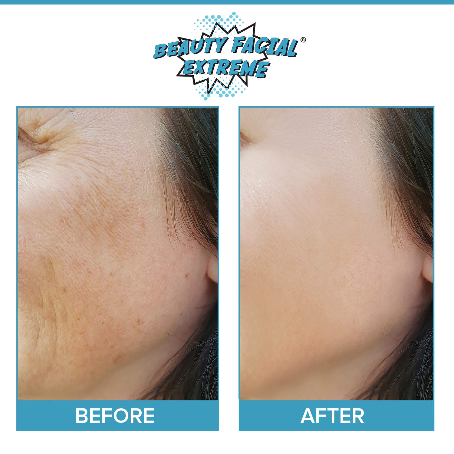 Anti Aging Resurfacing Chemical Peel Pads- Contains Lactic Acid, Salicylic Acid & Glycolic Acid for Face & Body. Repairs Fine Lines, Wrinkles, Dark Spots, Pores, Scars & Uneven Skin Tone.: Beauty