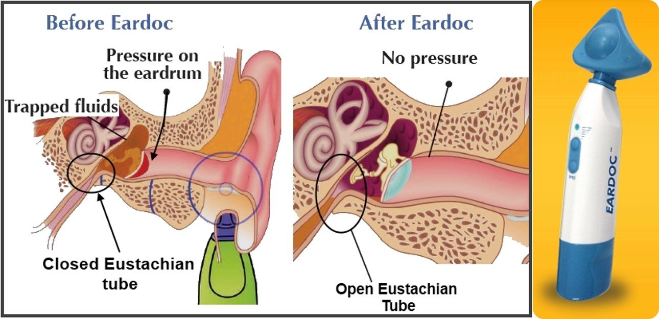 Eustachian Tube Surgery Cost About Eustachian Tube Dysfunction TTXMT Eustachian Tube Surgery Cost About Eustachian Tube Dysfunction TTXMT