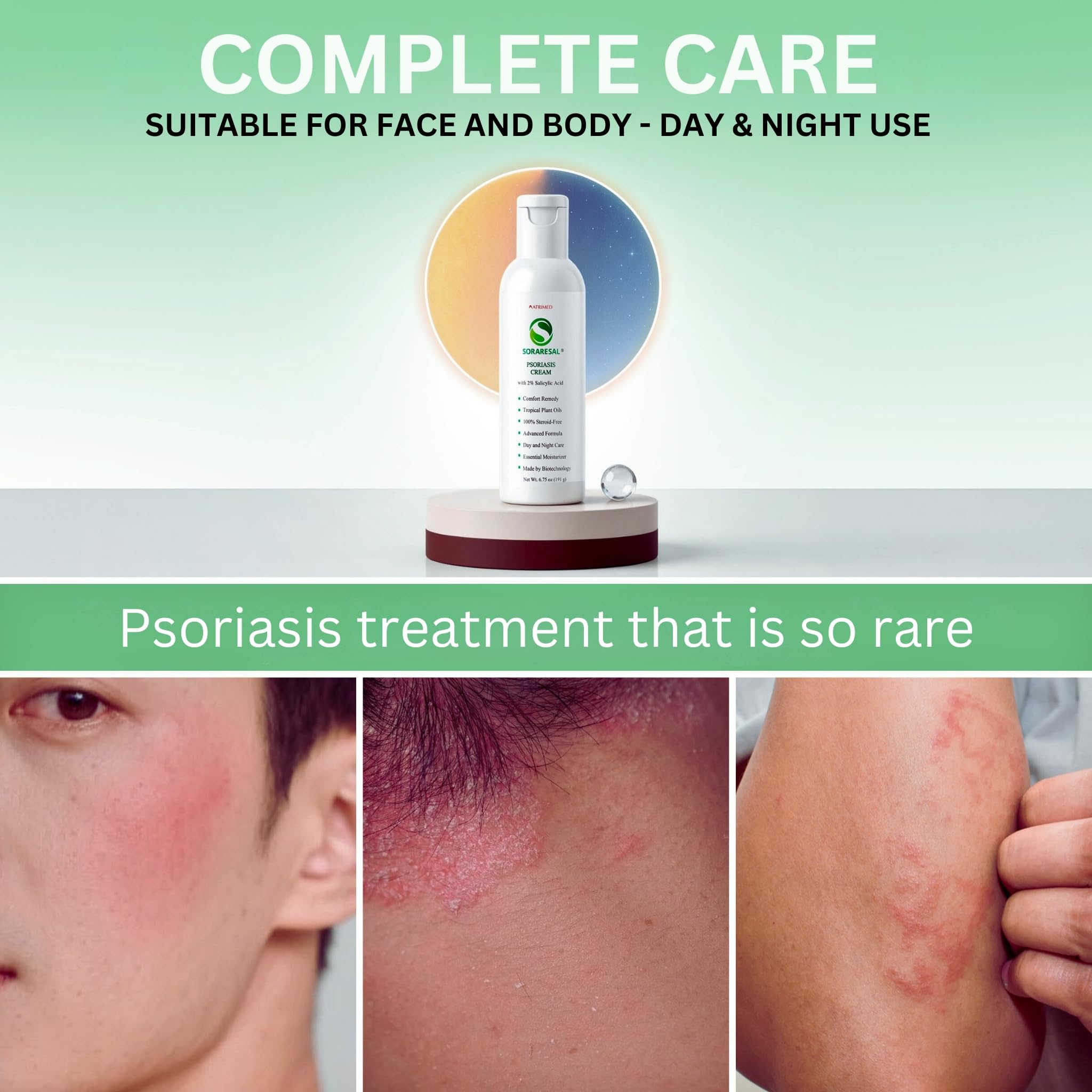 SORARESAL Psoriasis Cream - Comfort Remedy with Safflower Oil, Coconut Oil and Salicylic Acid – Eczema Cream for Itchy, Flaky Skin and Eczema Relief