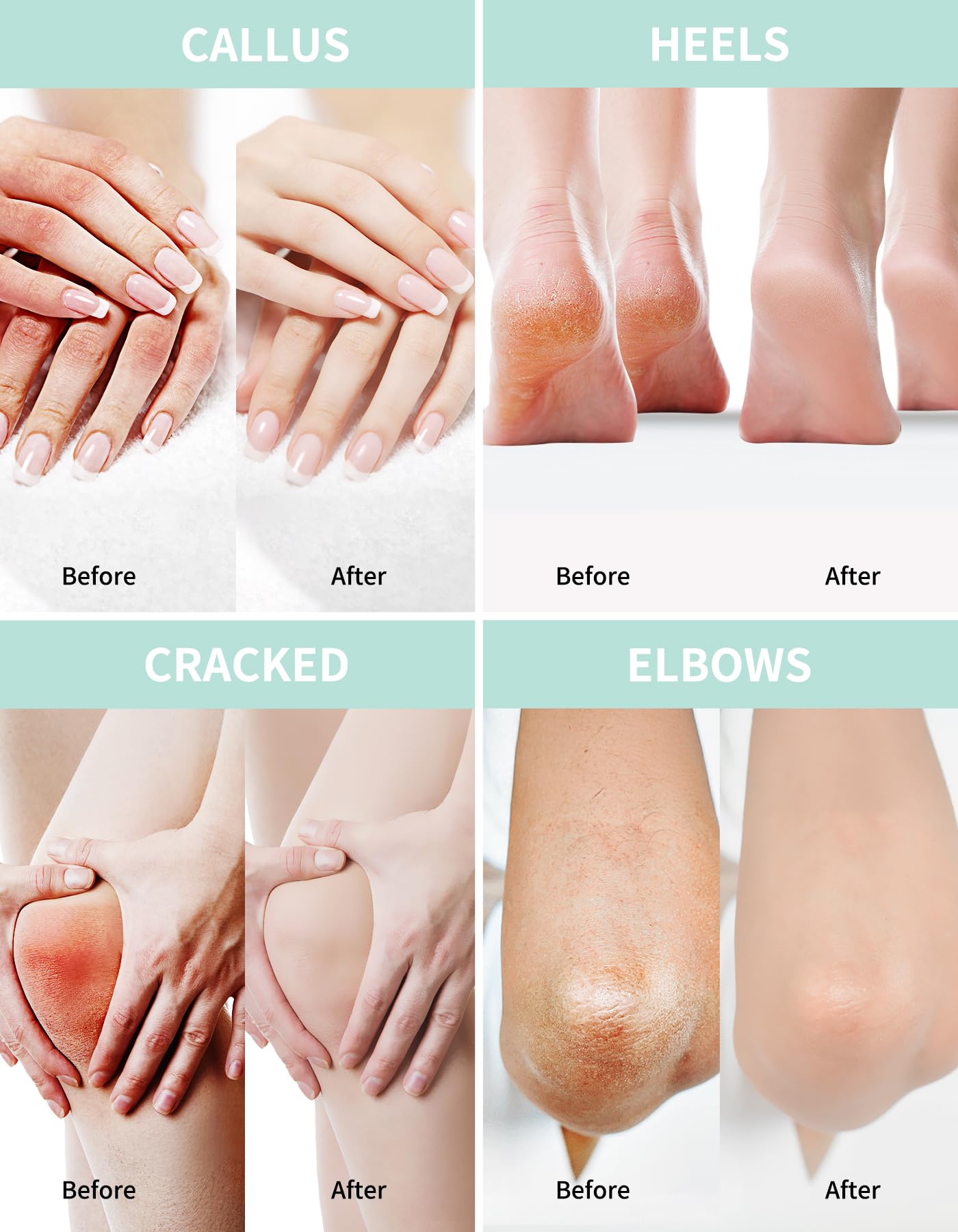 Urea Creme 40 prozent 150 Gramm || Hornhautentferner Fußcreme, Handcreme, Bodylotion mit Hyaluronsäure, Teebaum und Aloe Vera für tiefe Feuchtigkeit, Kallusentferner und Erweichung 8