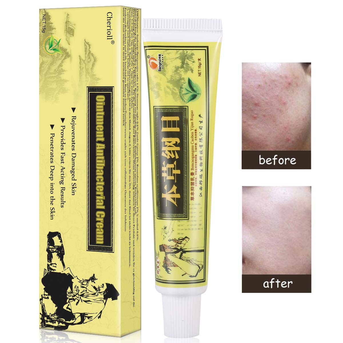 Psoriasis Treatment,Psoriasis Cream for Dermatitis, Eczema,Natural